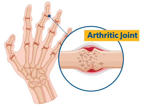 attrities
